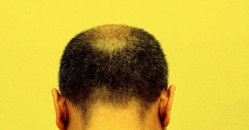 Scientists Are Working on a Gene-Hacking Drug That Could Treat&nbsp;Baldness
